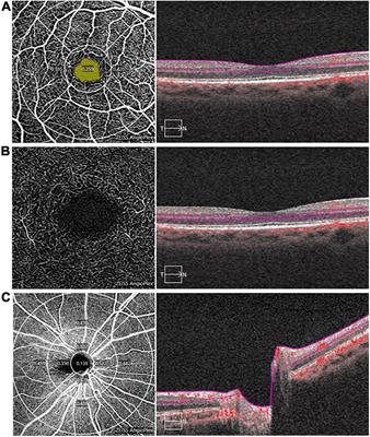 Development of a Novel Retina−Based Diagnostic Score for Early Detection of Major Depressive Disorder: An Interdisciplinary View